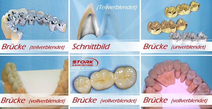 Bilder der versiedenen beschriebenen Versorgungen