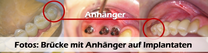 Fotos: Brücke mit Anhänger auf Implantaten